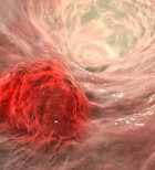 פוליפקטומי - תמונת אווירה